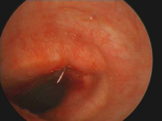 Appropriate site of entry into trachea for tracheotomy determined with 25 gauge needle placed percutaneously through previous tracheotomy site