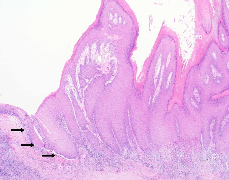 One side of the carcinoma showing the junction of normal mucosa and tumor (black arrow) that bulges into the submucosa.