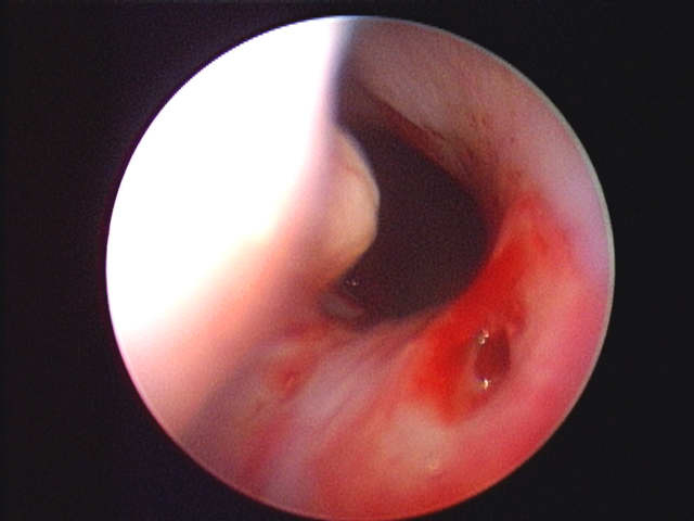 right nasal exam showing defect through to nose
