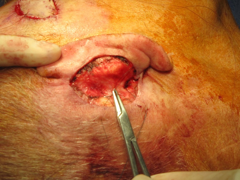 Entry through skin, engaging deep tissue anteriorly (needle placement showing), and replacement back through skin permits the half-buried mattress suture to advance the skin and obliterate dead space