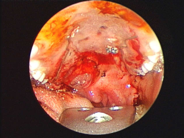  clear plastic dental obturator secured with screws through to palate        