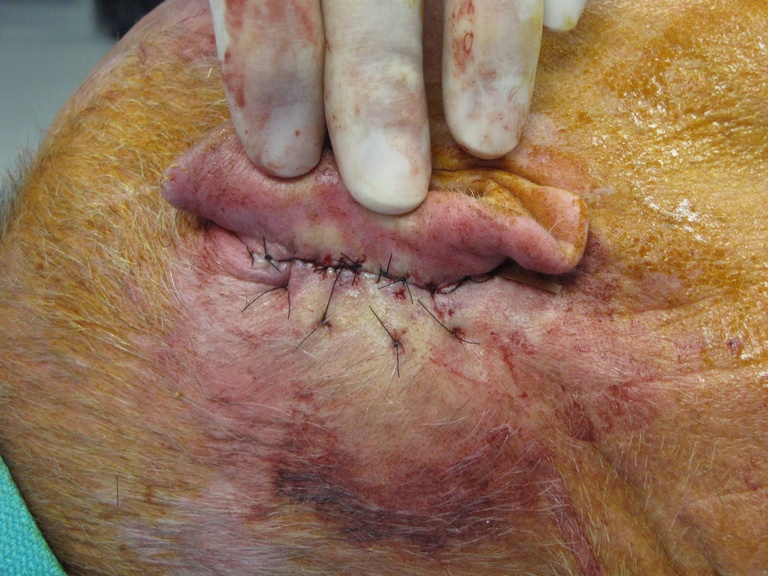 Four separate 'half-buried mattress' sutures in place with closure