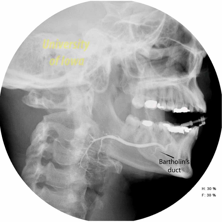 013a%20sialogram%20bartholins%20with%20arrow.jpg