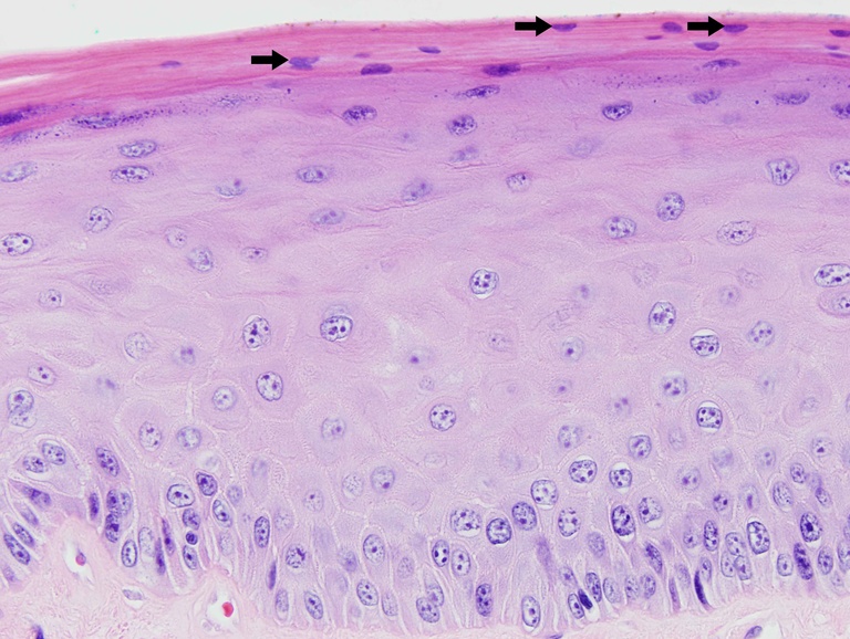 Exposure to inhalational irritants is one mechanism that may lead to surface nuclear retention (arrows).