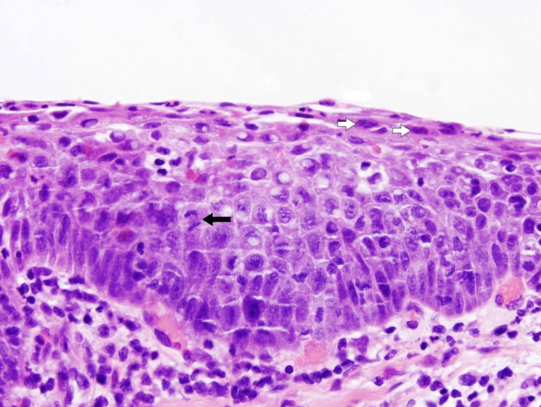 This biopsy shows marked nuclear hyperchromatism and pleomorphism with a high degree of basal layer expansion. A mitosis (black arrow) is noted in the middle half and abnormally large cells are present near the surface (white arrows).