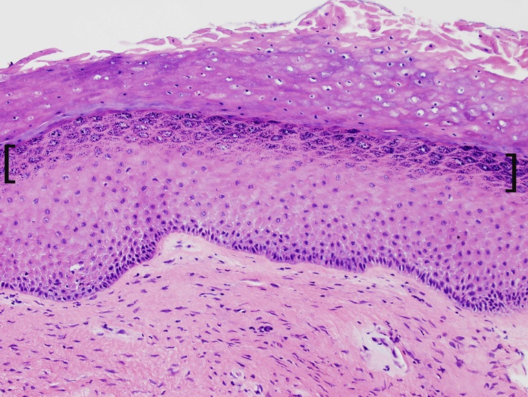 This mucosa shows a dense granular cell layer (brackets) beneath dense orthokeratin. 