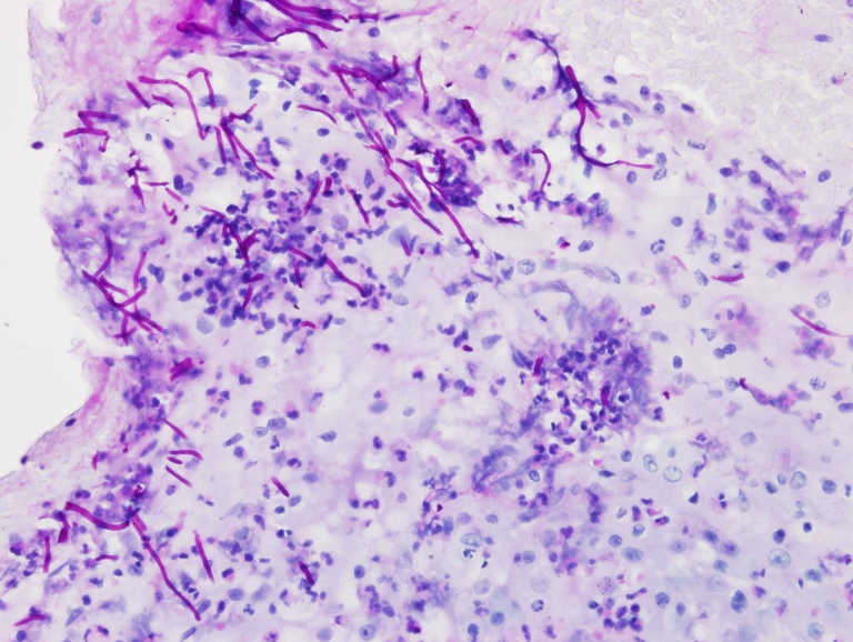 Periodic Acid-Schiff/Diastase (PAS/D) stain highlighting numerous candidal pseudohyphae