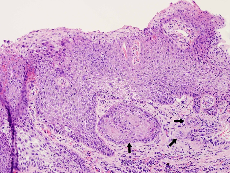 Intermediate magnification of a left true vocal cord lesion showing invading nests (black arrows) of malignant cells within the superficial submucosa.