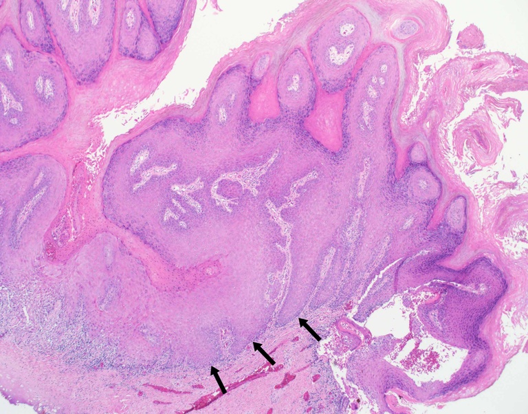 Opposite aspect of the tumor showing the bulbous, broadly invasive front (black arrow) juxtaposed to the normal mucosa