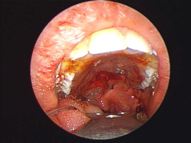 distant view of obturator in place