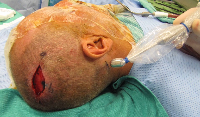 Resection of primary site is done first - with planning for incision for SLN bx directed by gamma probe and consideration for potential need for subsequent surgery if node positive (postero-lateral neck dissection)
