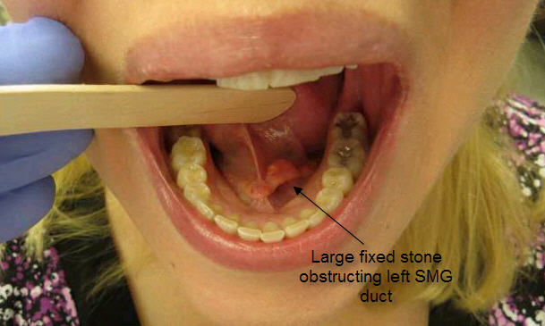 015%20annotated%20stone%20in%20duct.jpg