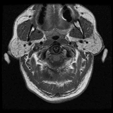 015%20sialosis%20MRI%2011022004%20resized.jpg