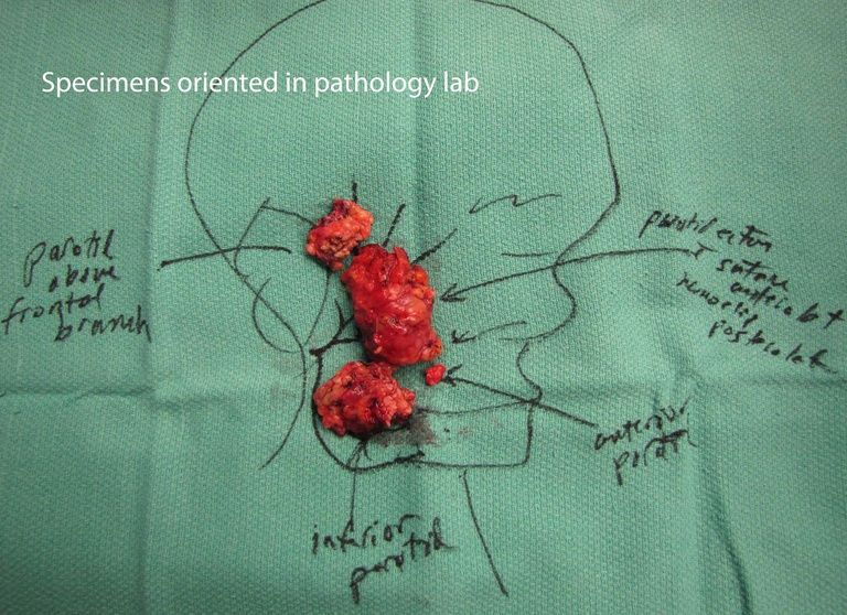 016%20buccal%20br%20resected.jpg