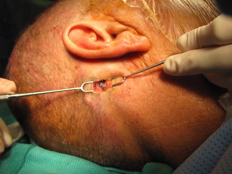 Superficial suboccipital node is identified with gamma probe with blue color (from methylene blue injection) further helping identification