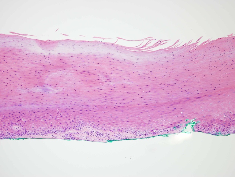 This biopsy shows thick parakeratosis as well as some atypia along the basal zone sufficient for a diagnosis of mild squamous dysplasia