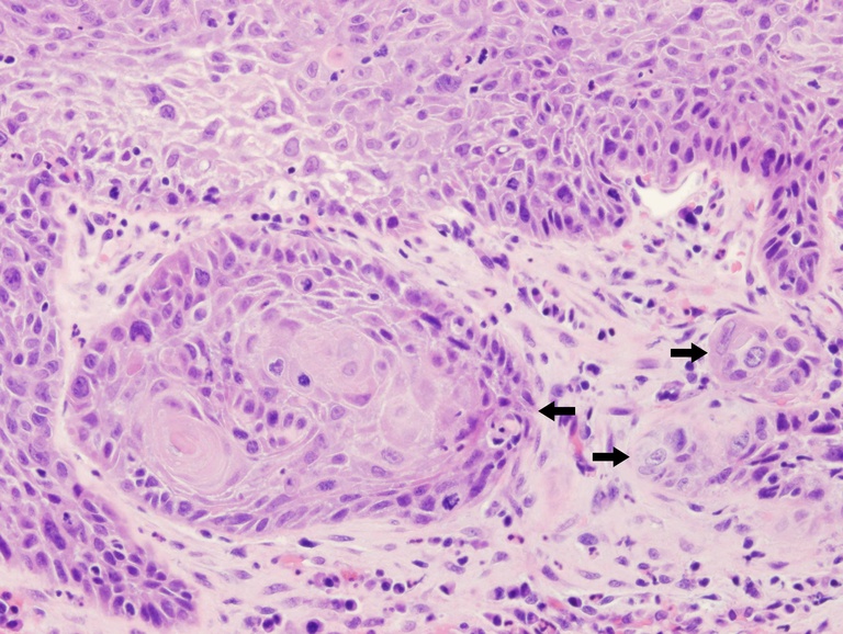 High magnification of prior biopsy shows nests of markedly atypical squamous cells (black arrows) invading into the submucosa. Note the squamous pearls, deep keratinization, and reactive appearance to the stroma.