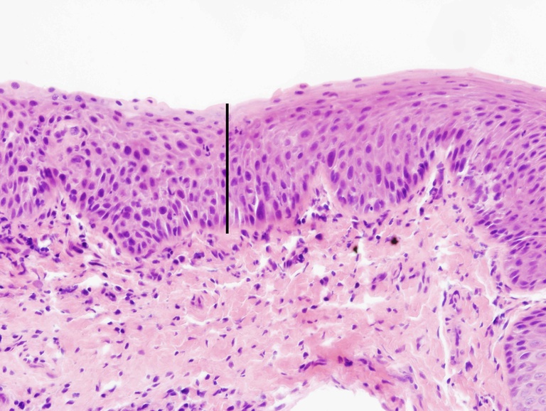 This biopsy is interesting because is shows a transition of carcinoma in situ (left of black line) to a lower degree of dysplasia (right of black line). On the left, there is architectural disorder, more nuclear hyperchromatism, and basal layer expansion.
