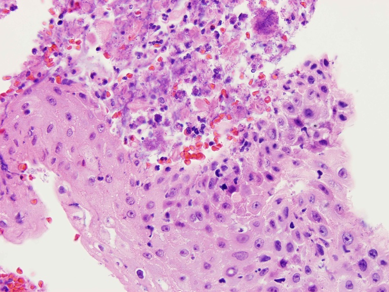 Reactive squamous mucosa with surface fibrino-inflammatory infiltrate.