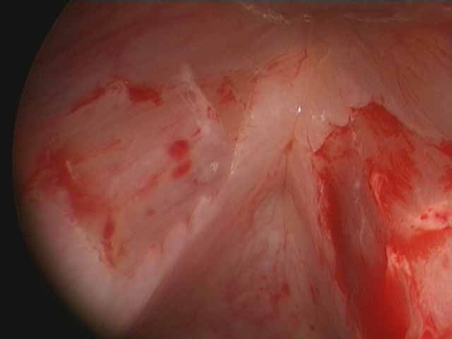   70 degree telescope for endoscopic imaging after resection