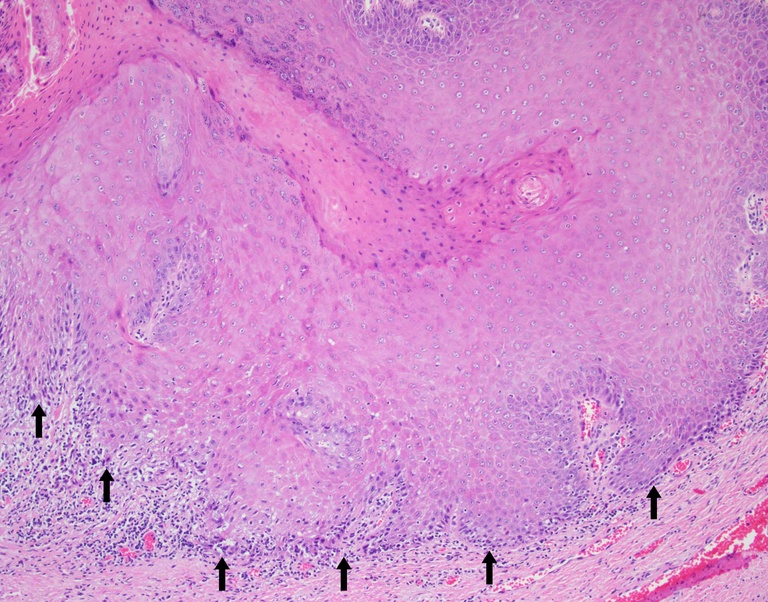 High power examination of the tumor's invasive front showing extremely well-differentiated tumor cells with minimal cytologic atypia associated with a chronic inflammatory host response
