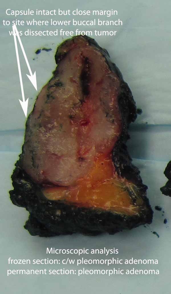 018%20buccal%20br%20resected.jpg