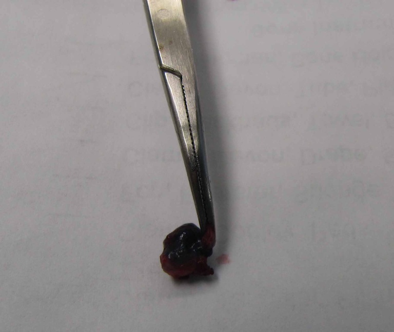 Appearance of resected blue node. Note that grasping soft tissue adjacent the node (and not the node itself) facilitates traction during removal