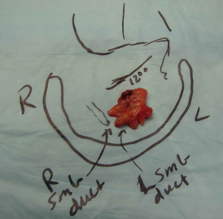 01ductoplasty%20a.jpg