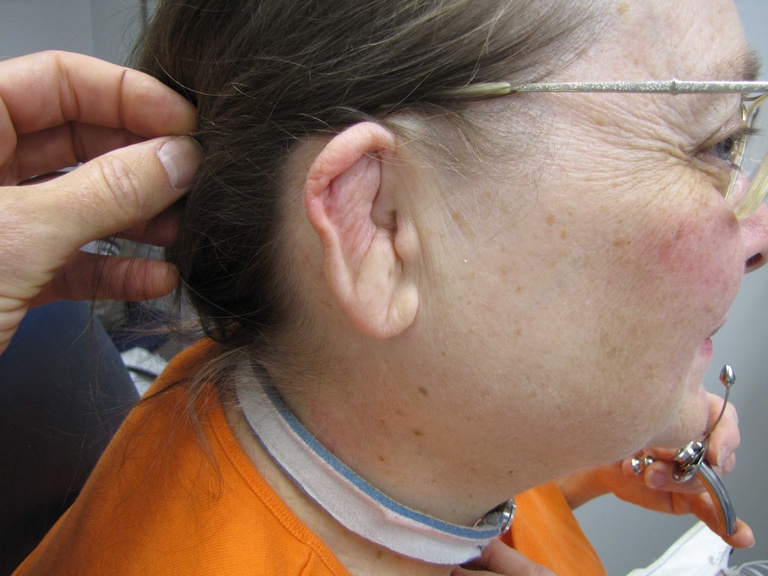 Appearance of auricle before beginning cellcept and prednisone