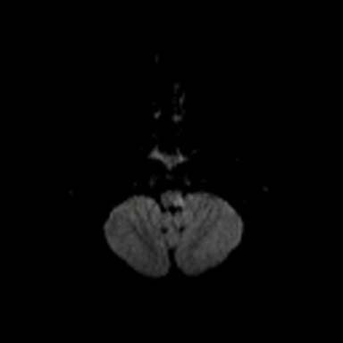 02 mri 122110 left lat medullary infarcta.jpg