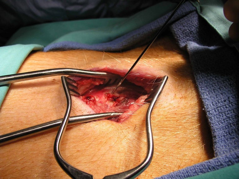 Sialendoscope placed into Reinke's space through anterior opening in thyroid cartilage
