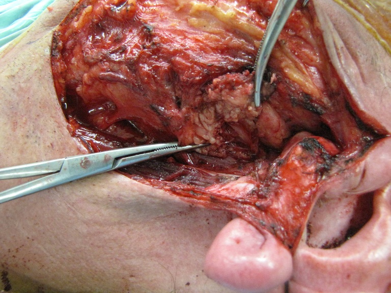 02%20parotid%20b.jpg