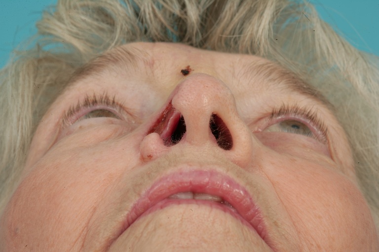 Preop Basal view 
