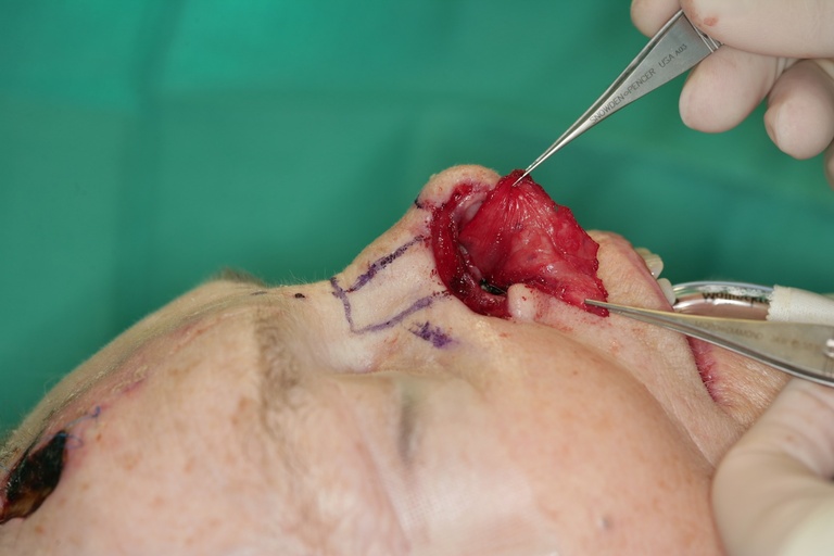   1st Stage Intraop-Septal Hinge Flap for internal lining  