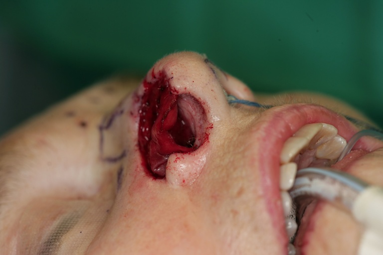 1st Stage Intraop-Basal view of Septal Hinge Flap 