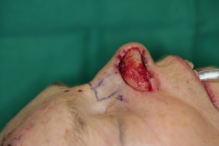 1st Stage Intraop-Conchal Cartilage graft-Lateral view