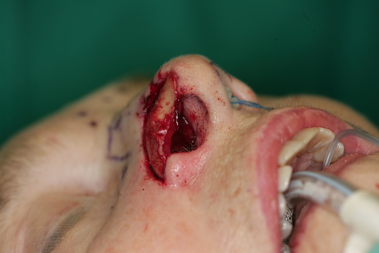 1st Stage Intraop-Conchal Cartilage graft-Basal view