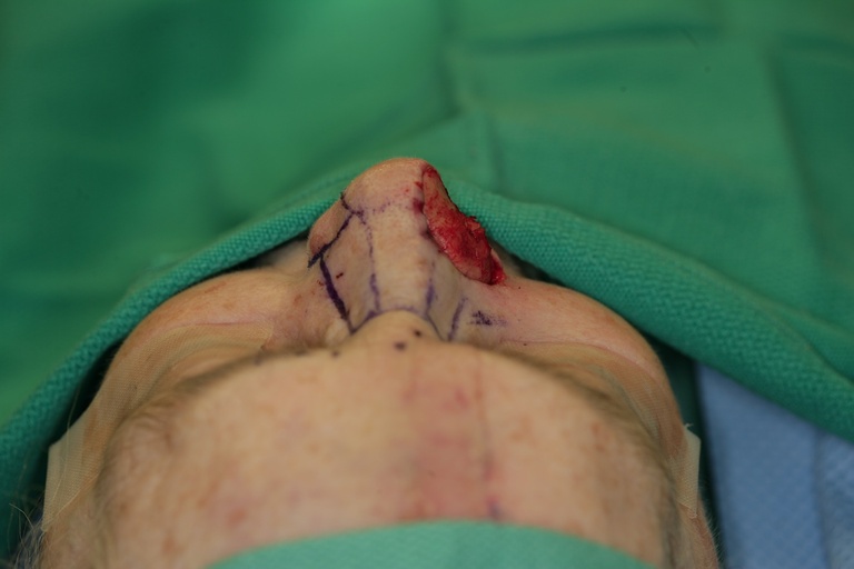 1st Stage Intraop-Conchal Cartilage graft-Superior view