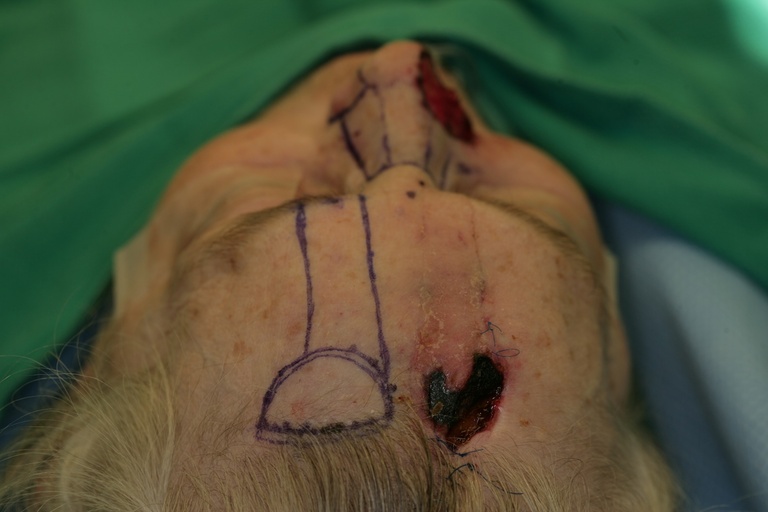 1st Stage Intraop-Contralateral forehead flap designed (previous failed forehead flap visualized) 