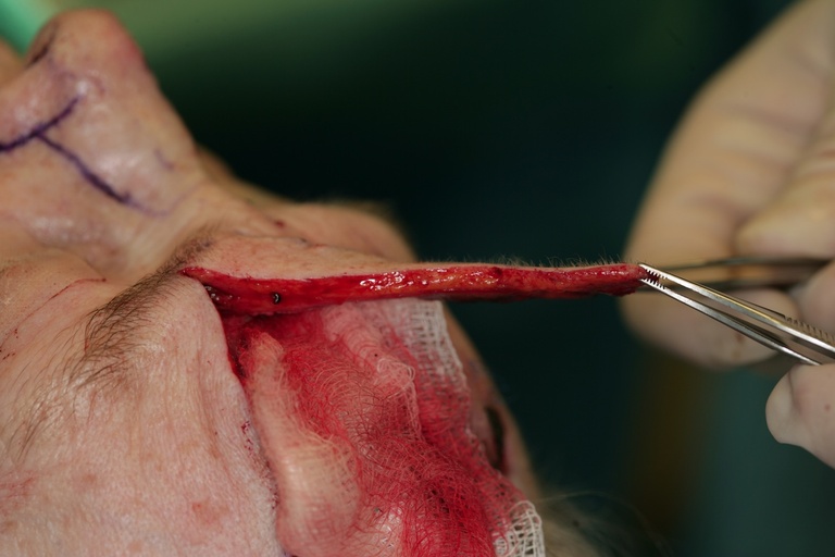 1st Stage Intraop-Forehead flap elevated and thinned distally