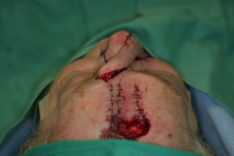 1st Stage Intraop-Forehead flap inset-Superior view
