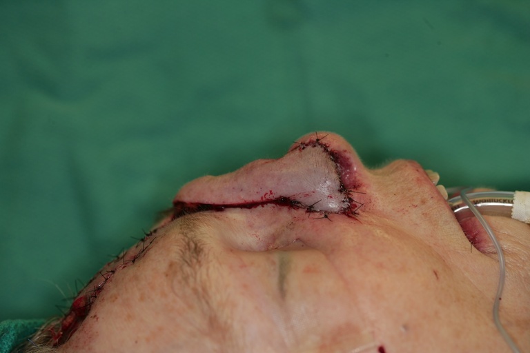 1st Stage Intraop-Forehead flap inset-Lateral view 