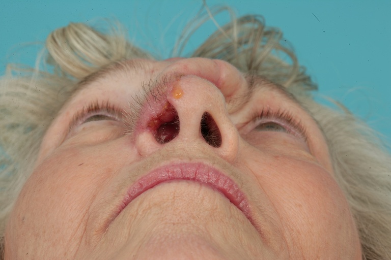 3 weeks post 1st stage-Basal view 