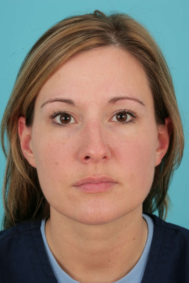 Anterior Preop