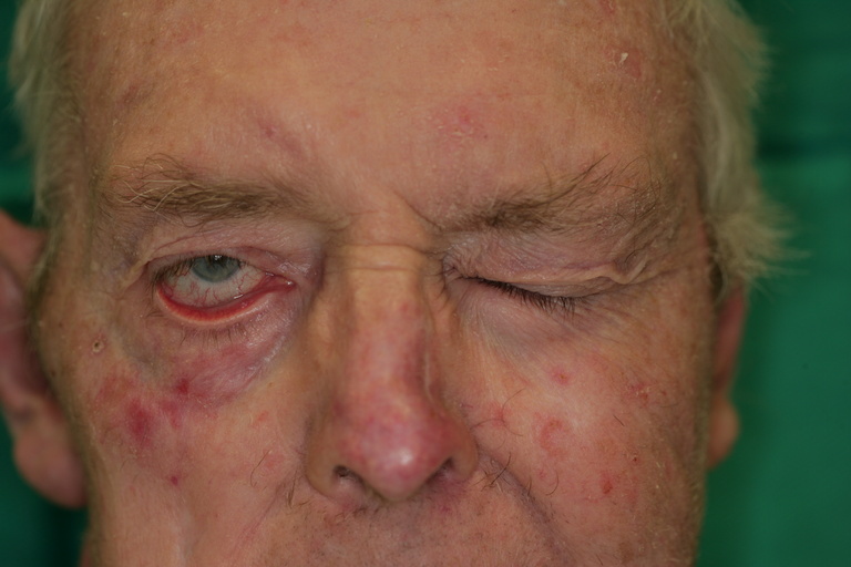 Preop closing eyes