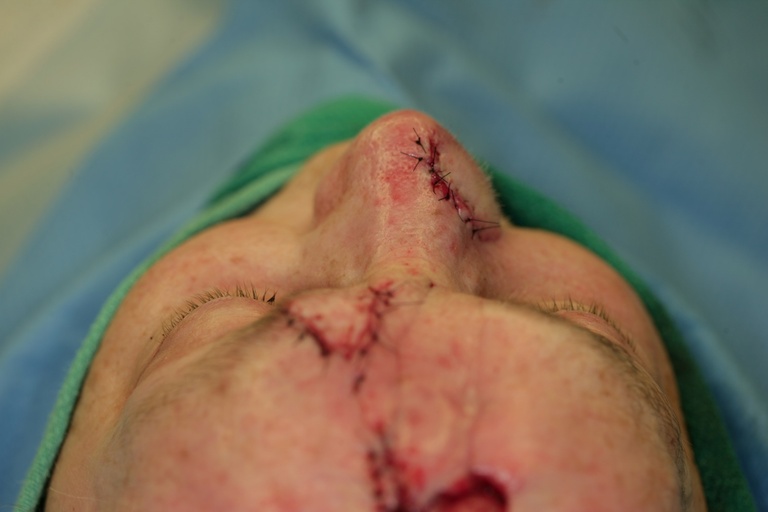 Intraop 2nd stage-Flap inset into nose-Superior view 