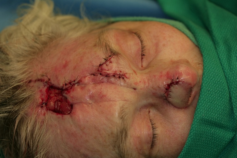 Intraop 2nd stage-Flap inset into nose-Anterior view 