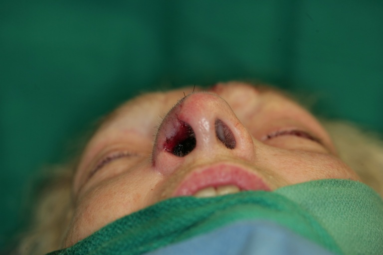 Intraop 2nd stage-Flap inset into nose-Basal view 