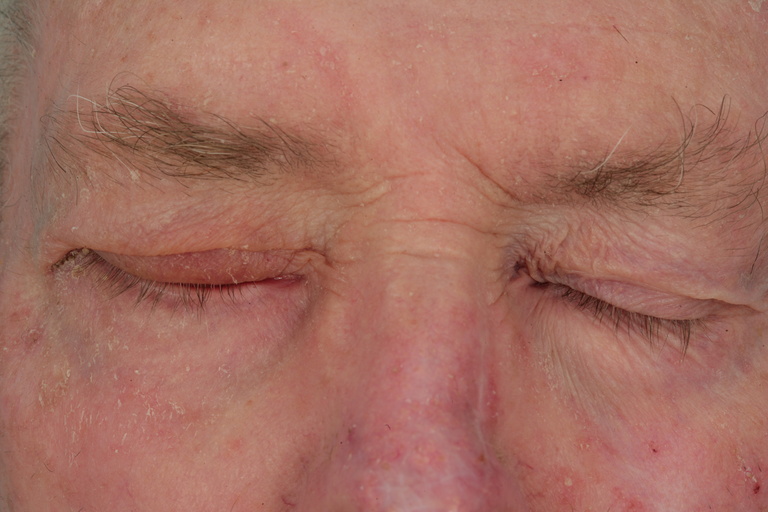Postop Closing Eyes