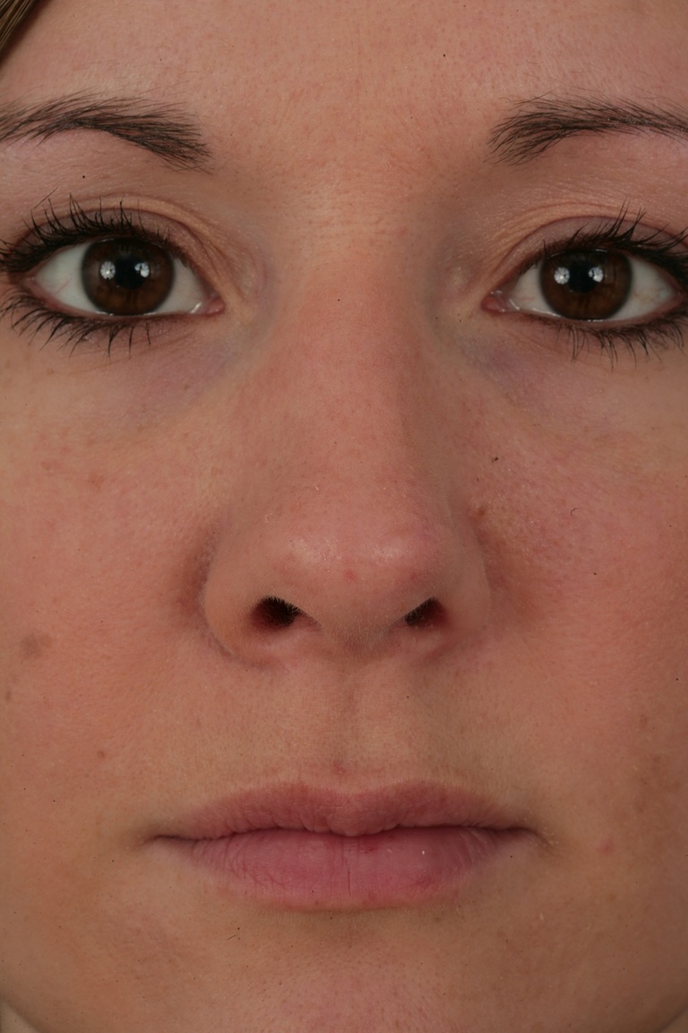 Close up Postop